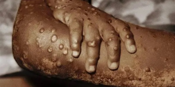 Mpox declared public health emergency in Africa