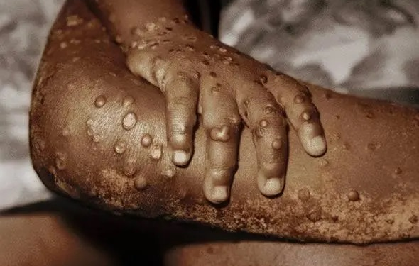 Mpox declared public health emergency in Africa