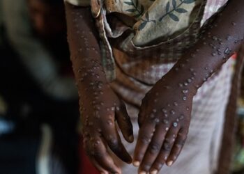 ‘Mpox is deadly—treat it like COVID-19,’ – Public Health Expert warns